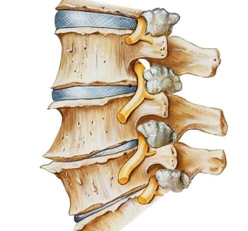 Pinch of the nerve of the spine