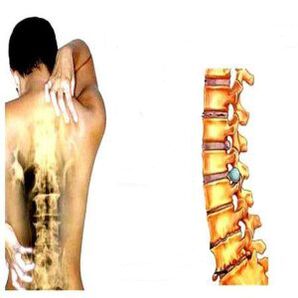 Stages of osteocondrosis