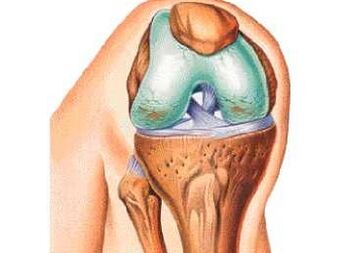 Basic reasons for knee artosis