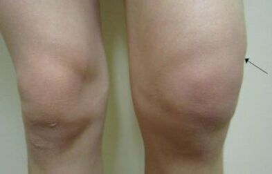 Clinical manifestations of artery of the knee joint