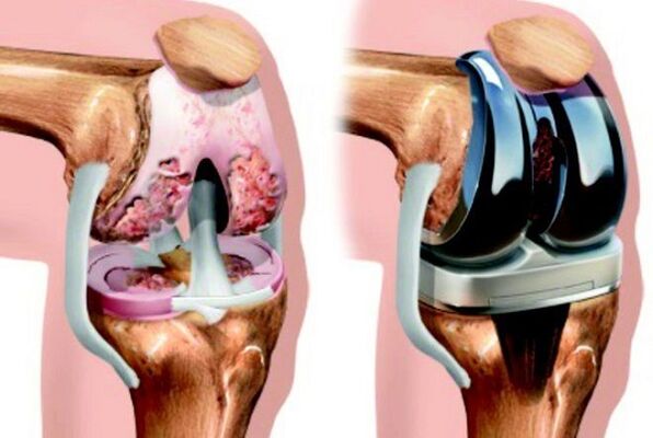Before and after the endoprostetics of knee joint with Arthosis