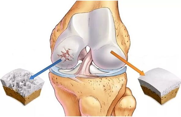 Healthy cartilage and cartilage affected by arthros