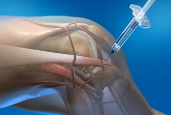 Non-dependent injections for knee joint arthrosis