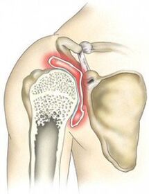 Destruction of the shoulder joint due to arthrosis