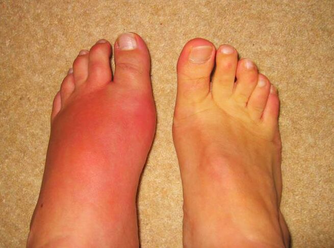 pain in leg joints due to gout