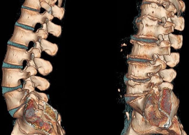 Osteochondrosis of the spine on CT
